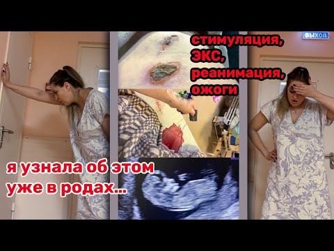Видео: МОИ РОДЫ: ВНЕЗАПНО ВЫЯВЛЕННАЯ АНОМАЛИЯ🩸7ч схваток, а РАСКРЫТИЕ 0🩸«У НЕЕ НЕ СОКРАЩАЕТСЯ МАТКА!!!»