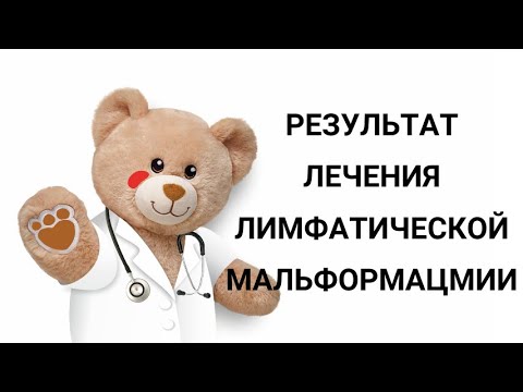 Видео: Результат лечения лимфатической мальформации (лимфангиомы)