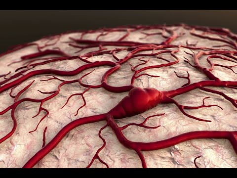 Видео: Сосудистые мальформации.  Доктор Сомсиков.