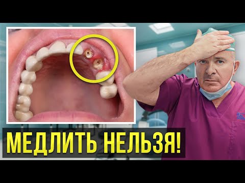 Видео: Остался только корень зуба! Что делать и как лучше восстановить?