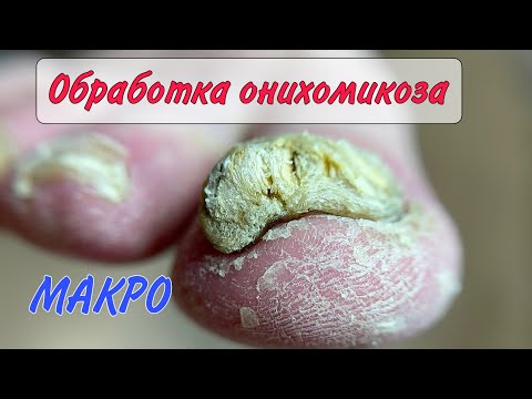 Видео: 🍄ГРИБОК ногтей / ОНИХОМИКОЗ / медицинский педикюр