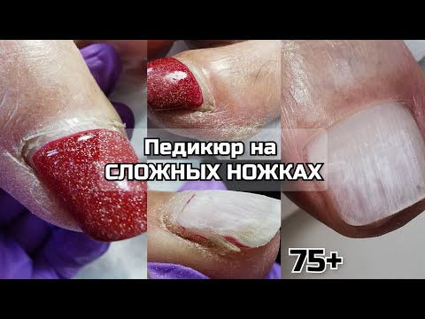 Видео: 75+❤️ПЕДИКЮР НА СЛОЖНЫХ НОЖКАХ🔥Как отодвинуть ПРИЛИПШУЮ КУТИКУЛУ⁉️Чистый педикюр 🎁