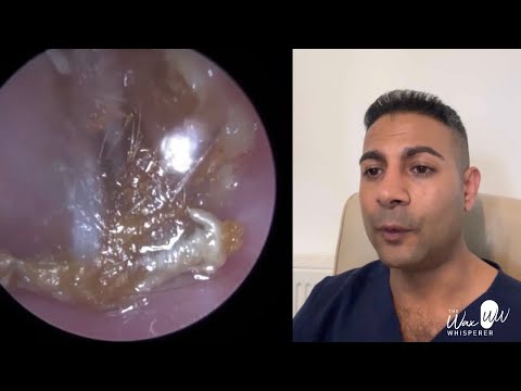 Видео: 1513 — Холестеатома слухового канала обнаружена после сложного удаления ушной серы