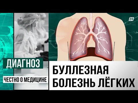 Видео: Что такое буллезная эмфизема лёгких и как не умереть от обычного кашля? | Диагноз