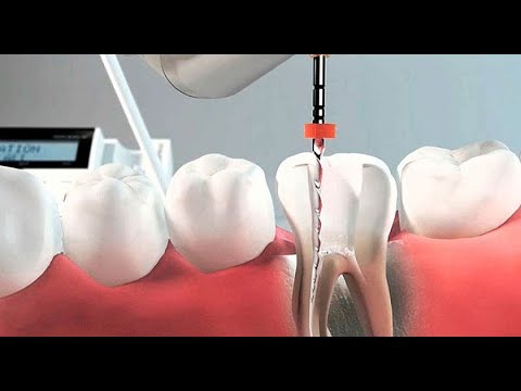 Видео: Механическая обработка корневых каналов