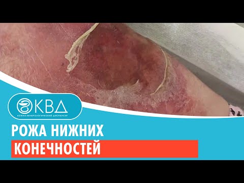 Видео: 😲 Рожа нижних конечностей. Клинический случай №913