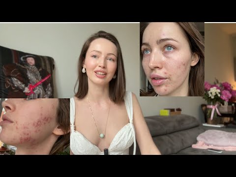 Видео: 💊АКНЕКУТАН. Полностью пропила курс. Часть 1