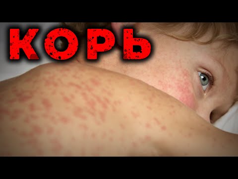 Видео: Корь. Диагностика и лечение на этапе Скорой помощи. #ПроСМП