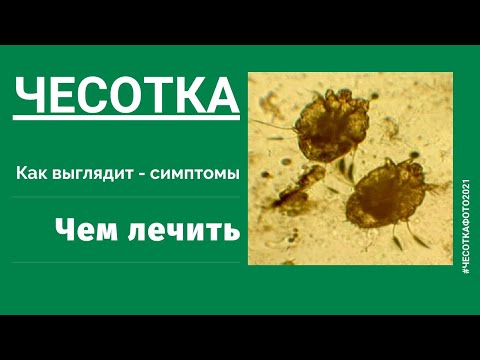 Видео: Чесотка. Все о ней и главное о лечении и профилактике