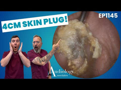 Видео: Кератиновая пробка удалена на 4 см – глубокая экстракция кожи уха! - EP1145