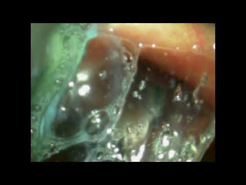 Видео: 5 интубация пример D клинок storz