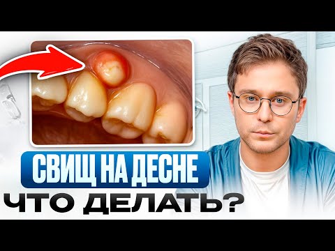 Видео: Гнойная шишка на десне ведет к ПОТЕРЕ ЗУБОВ?! / Как БЫСТРО избавиться от свища на десне?