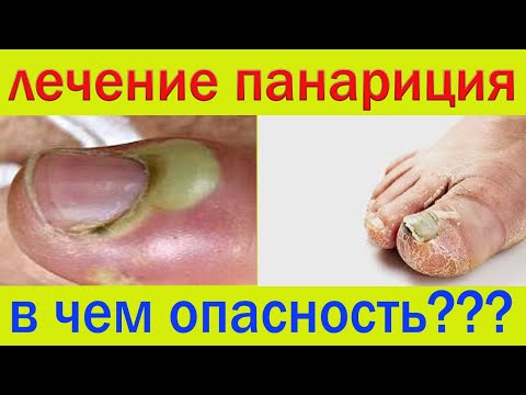 Видео: Как быстро вылечить панариций в домашних условиях..