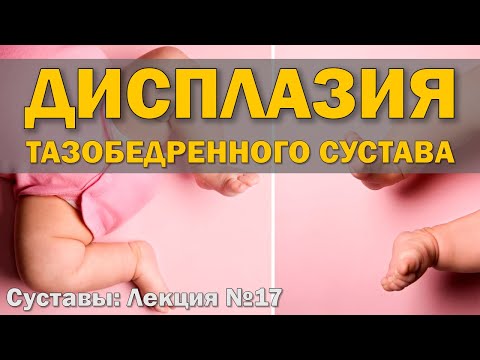 Видео: Дисплазия тазобедренного сустава [S05E17]