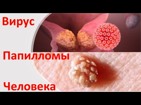 Видео: Вирус папилломы человека