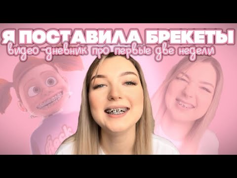 Видео: МОИ ПЕРВЫЕ ДВЕ НЕДЕЛИ С БРЕКЕТАМИ/уход за брекетами/что я ем и как справляюсь с дискомфортом?