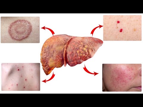 Видео: Кожные Признаки, Говорящие О Том, Что Ваша Печень В Беде