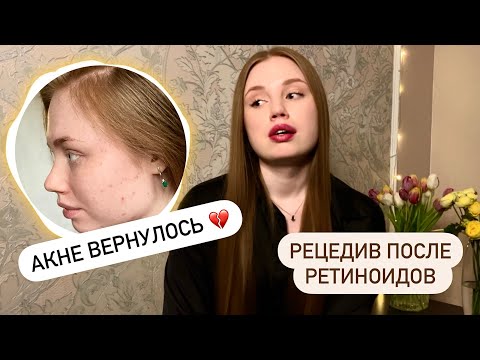 Видео: Рецедив акне после ретиноидов / Акне вернулось / Наружное лечение акне / Эффезел