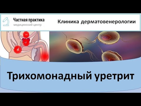 Видео: Трихомонадный уретрит