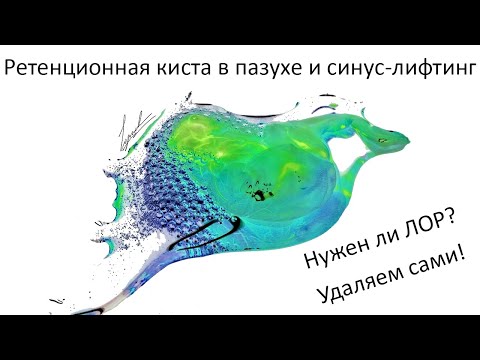 Видео: Неуловимая ретенционная киста, ушивание перфорации в синусе, открытый синус-лифтинг, полный разбор