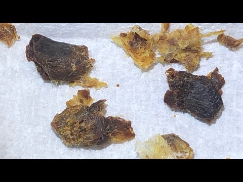 Видео: 910 - Извлечение крупных омертвевших пробок и ушной серы