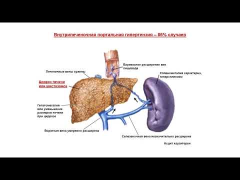 Видео: Ультразвуковая диагностика (УЗИ). Доктор Иогансен. Портальная гипертензия.