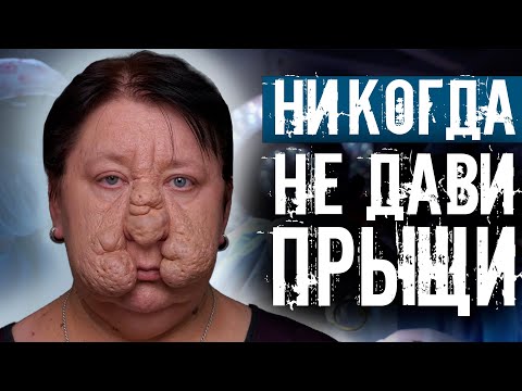 Видео: ПЛАСТИЧЕСКИЕ ХИРУРГИ МЕЛЬНИКОВ И ГЛУШКО СПАСЛИ ЛИЦО. ЖИЗНЬ ДО И ПОСЛЕ