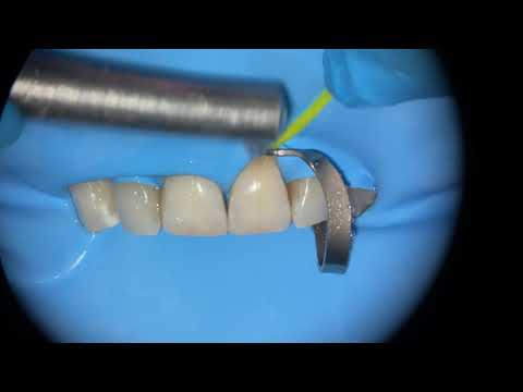 Видео: Прямая реставрация . Пришеечный кариес. Direct restoration. PART1