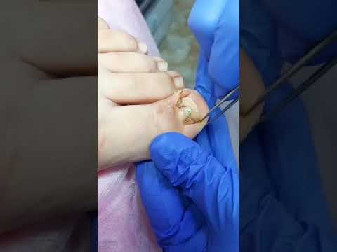 Видео: Лечение вросшего ногтя и установка скобы (видео 5) - Подолог Елена Баскова