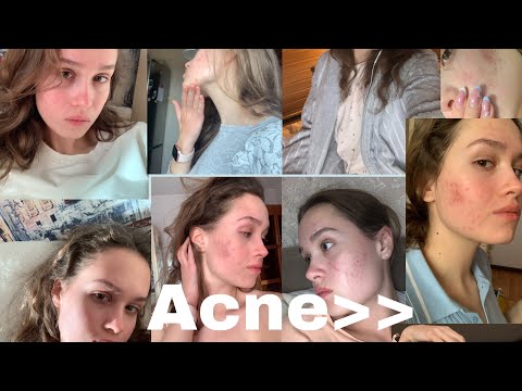 Видео: как я лечила акне. ретиноиды, сотрет 