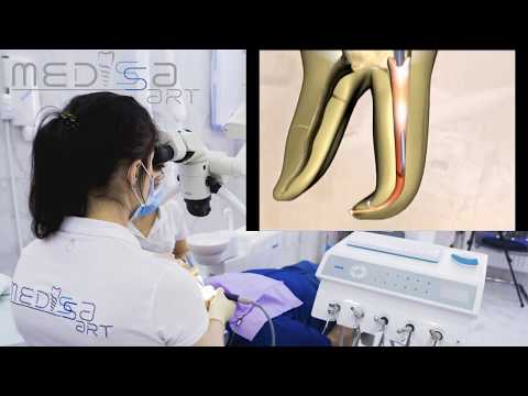 Видео: Пломбирование корневого канала системой BeeFill