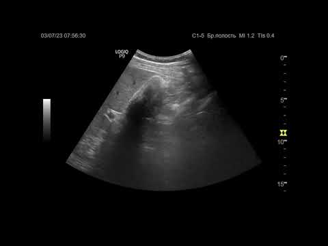 Видео: Ультразвуковая диагностика. Доктор Иогансен. Видеопримеры. Выпуск 32. Отключенный желчный пузырь.