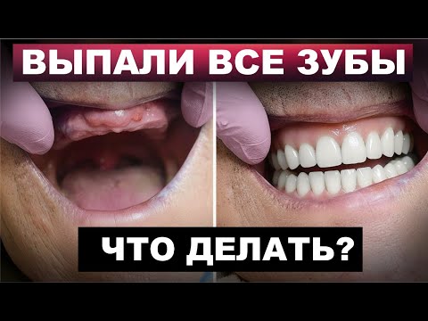 Видео: Не осталось ни одного зуба во рту? | Что делать?
