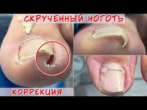 Видео: Скрученные ногти / Установка титановой нити