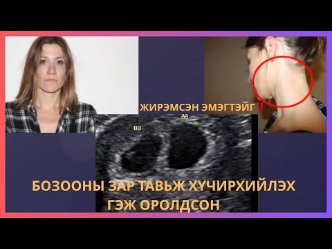 Видео: 6 САРТАЙ ЖИРЭМСЭН ЭМЭГТЭЙГ НӨХРИЙНХ НЬ ЭКС....😱😱