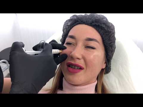 Видео: Radiesse - уникальный антидепрессант!!!