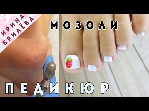 Видео: Убираем МОЗОЛЬ на стопе 🌺 Педикюр с жемчужной втиркой