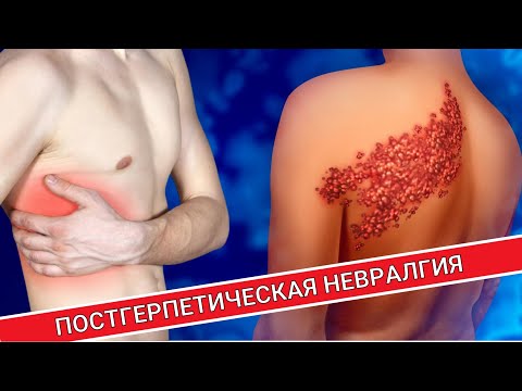 Видео: ПОСТГЕРПЕТИЧЕСКАЯ НЕВРАЛГИЯ ПОСЛЕ ОПОЯСЫВАЮЩЕГО ЛИШАЯ