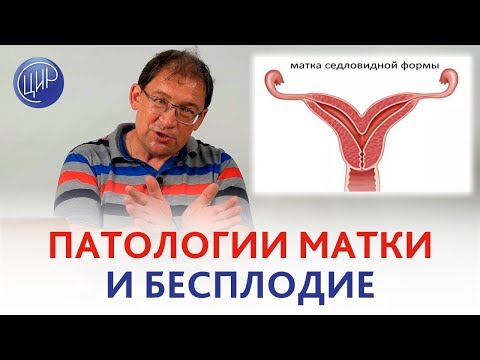Видео: БЕСПЛОДИЕ. Врождённые и приобретённые ПАТОЛОГИИ МАТКИ как причины бесплодия.