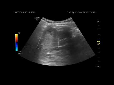 Видео: Ультразвуковая диагностика. Доктор Иогансен. Видеопримеры. Выпуск 76. Опухоль селезенки.