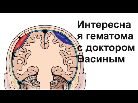 Видео: Интересная гематома с доктором Васиным
