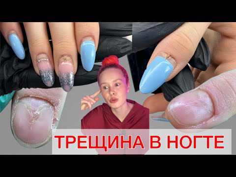 Видео: ТРЕЩИНА В НОГТЕ | ЧТО ДЕЛАТЬ ЕСЛИ ТРЕСНУЛ НОГОТЬ? ТРЕЩИНА НА НОГТЕ | КАНАЛООБРАЗНАЯ ДИСТРОФИЯ