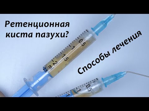 Видео: Ретенционная киста пазухи - что с ней делать? Закрытый синус-лифтинг, аспирация кисты, имплантация