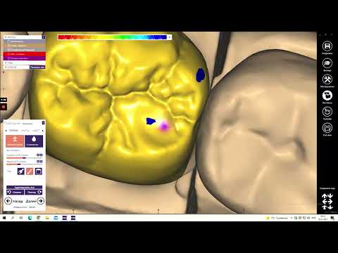 Видео: ExoCad моделировка 46 зуба