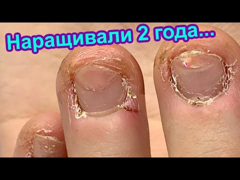 Видео: Что Стало С Ногтями Через 2 Года Постоянного Наращивания? Преображение Обкусанных Ногтей