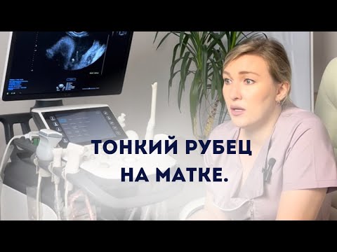 Видео: Тонкий рубец на матке.