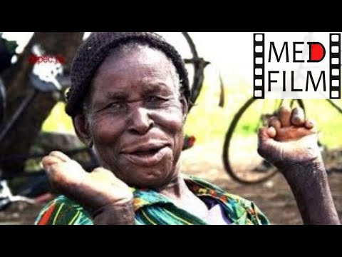 Видео: Лепра, проказа © leprosy