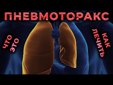 Видео: Пневмоторакс просто. Что это такое и как лечить? #ПроСМП