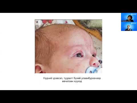 Видео: Улаанбурхан өвчний эмнэлзүйн заавар, Халдварын сэргийлэлтийн үндсэн зарчмууд