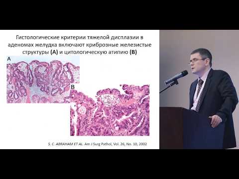 Видео: Особенности морфологической диагностики опухолей желудка на материале эндоскопических биопсий